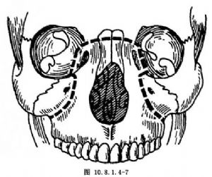 1.4-5).lefortⅡ型截骨术为比较复杂的一种正颌外科术式.