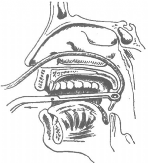 用導尿管由鼻腔插入咽部用海綿鉗將其一端引出口外