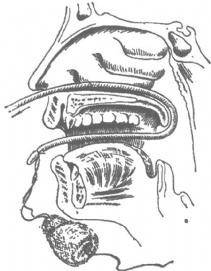 凡士林錐形紗布塊繫於導尿管口端