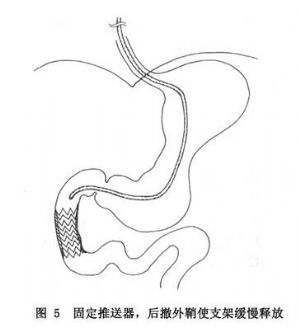 胃,十二指肠内支架置入术